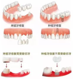 种植牙VS烤瓷牙哪种好