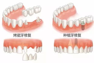 种牙还是装个活动的假牙