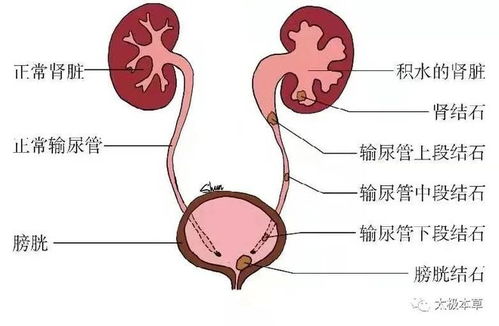 孕妇输尿管结石最快的排除方法是