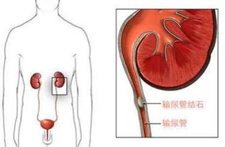 孕妇输尿管结石最快的排除方法是