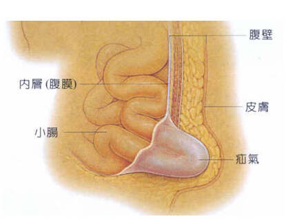 宫寒会导致新生儿疝气吗