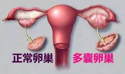 多囊卵巢综合症有什么常见症状吗