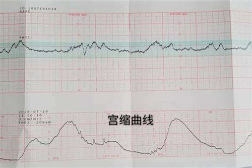 胎心监护不过关能顺产吗有影响吗