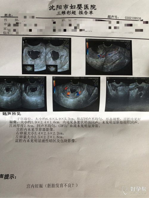 帮我看看我50天的孕囊是圆的还是长的