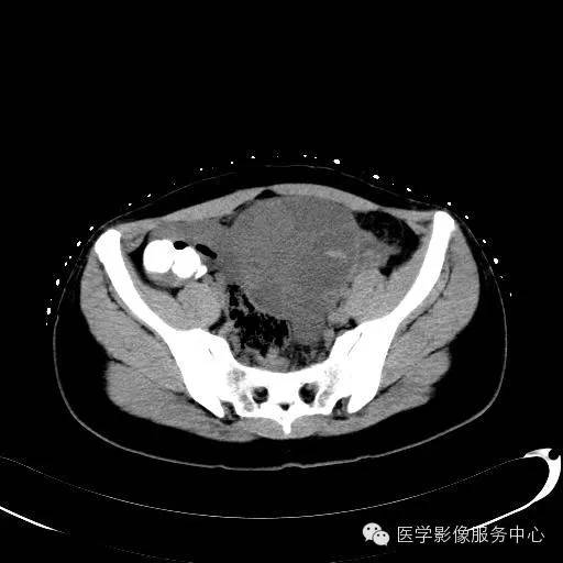 卵黄囊是啥