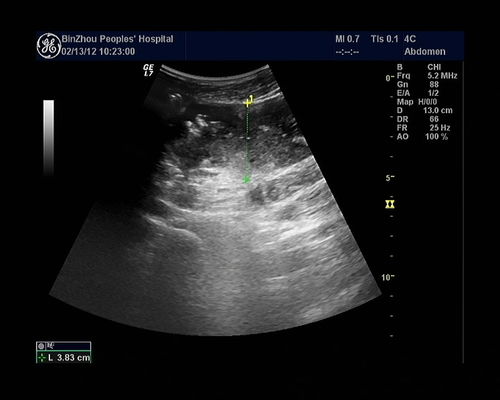 胎儿肠梗阻超声表现是怎样的