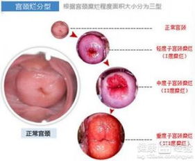 宫颈糜烂的饮食禁忌