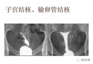 输卵管检查通水和造影哪个好