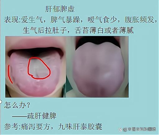 孕妇舌头齿痕怎么调理好