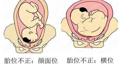 4种最易导致难产的胎位是