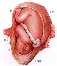 胎儿结肠扩张