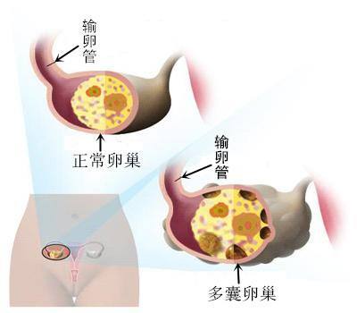 取完卵后腹水还能移植鲜胚胎吗