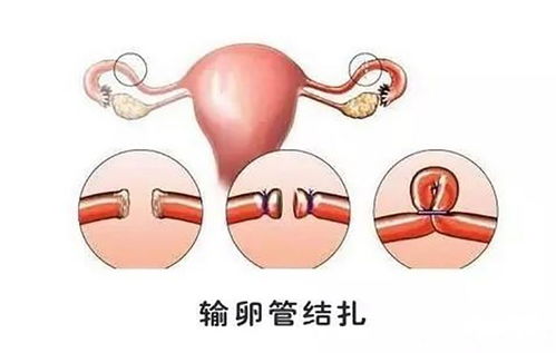 男性输精管复通手术难度高吗