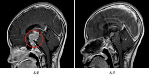 11岁儿童的骨龄达到15岁了，怎么办