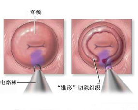 宫颈肥大是怎么回事 需要治疗吗糜烂