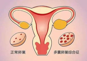 三十岁卵巢早衰怎么回事