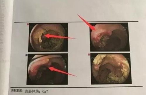 孕期应避免患上阑尾炎吗