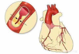 治疗心肌缺血的方法..