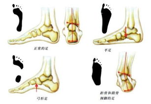 扁平足是什么原因导致的