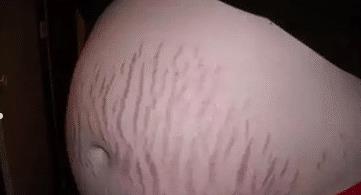 孕妇长妊娠纹怎么办?如何有效消除妊娠纹呢