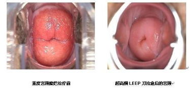 治宫颈糜烂偏方大全图片