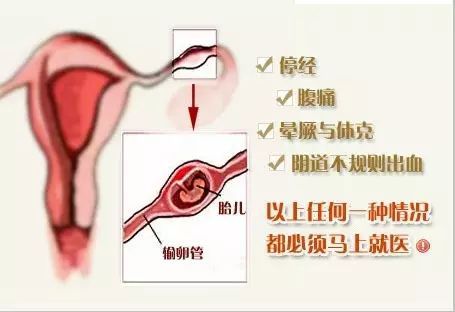 输卵管粘连怎么会怀孕