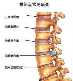 腰椎管狭窄吃什么药比较好啊