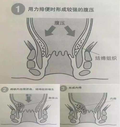 十个孕妇九个痔疮真的吗?