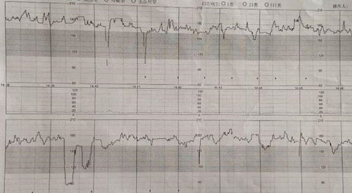 34周宝宝胎心在120到160 之间,胎动是超过160,偶尔到达170,是缺氧吗?要住院吗?