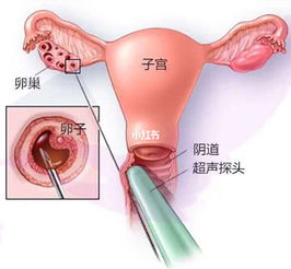 取卵后卵巢扭转是什么引起的