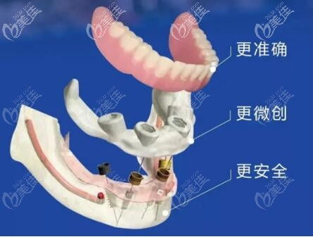 微创种植牙是什么？有什么优势？