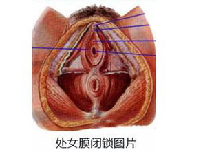 处于膜裂开会自动愈合吗