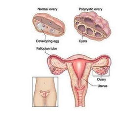为什么会得多囊卵巢综合症原因