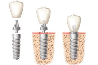 种植牙什么时候安装牙冠 种植牙的恢复时间