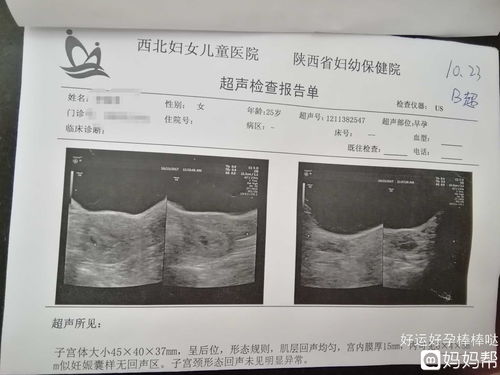 50天做B超未见孕囊?