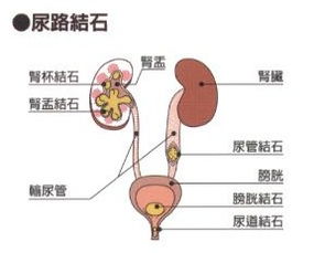 孕妇有输尿管结石平时应当注意什么问题