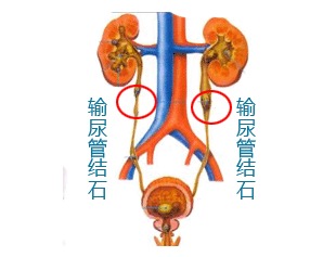 孕妇有输尿管结石平时应当注意什么问题