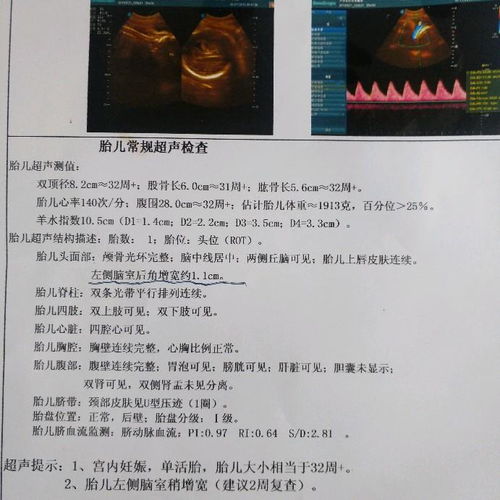 胎儿侧脑室增宽是脑积水吗严重吗