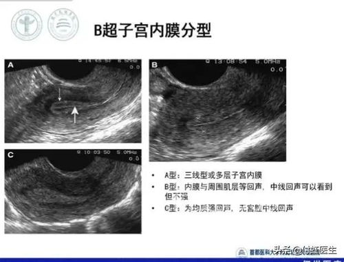 排卵监测是做b超还是阴超