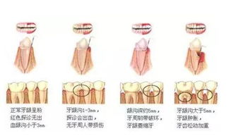 牙龈发炎买什么药?