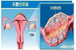 卵巢多囊样改变一定不好怀孕吗