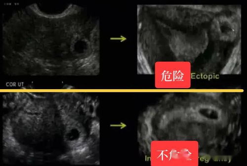 怀孕12周nt检查需要憋尿空腹吗