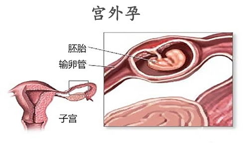 早期宫外孕可以药流吗