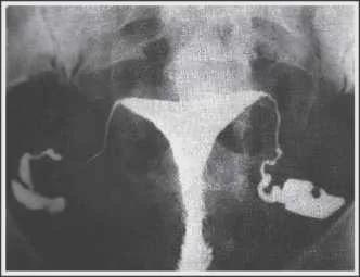 宫腔粘连怀孕了还能要吗