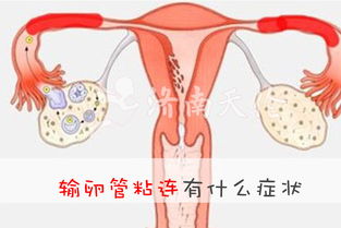 输卵管发炎有什么症状表现图片