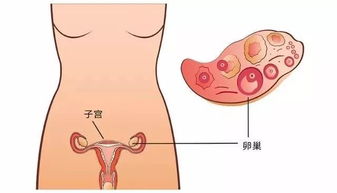 女人卵巢囊肿会影响怀孕吗