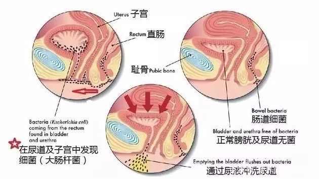 尿道炎会流脓吗?