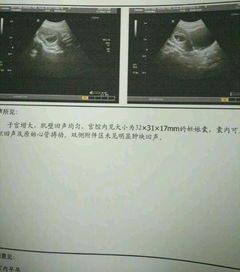 我怀孕7周了，但b超看不到孕囊，也没