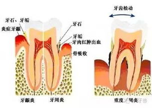 想弄个全口牙套，要多少钱？