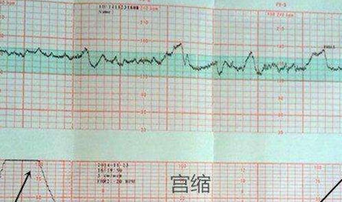 胎心监护宫缩40正常吗